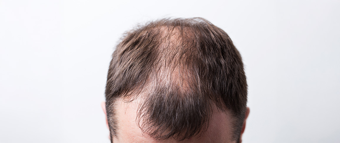 Haarausfall Mann Apotheke