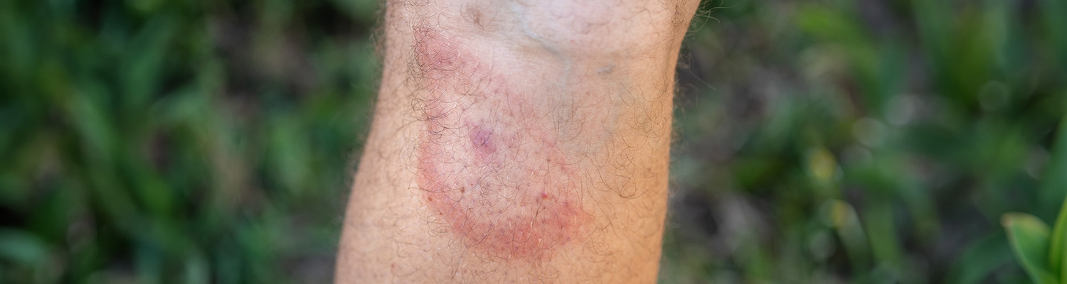 Wanderröte – eine kreisförmige Hautrötung nach einem Zeckenstich