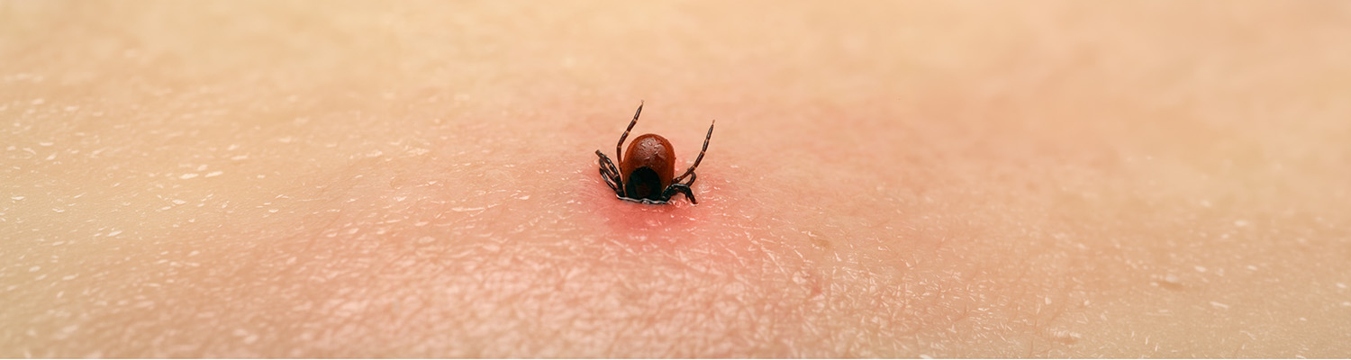 Zeckenstich auf der Haut