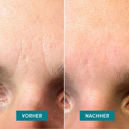 Apricot Gesichtspatches, Bild 4 von 4