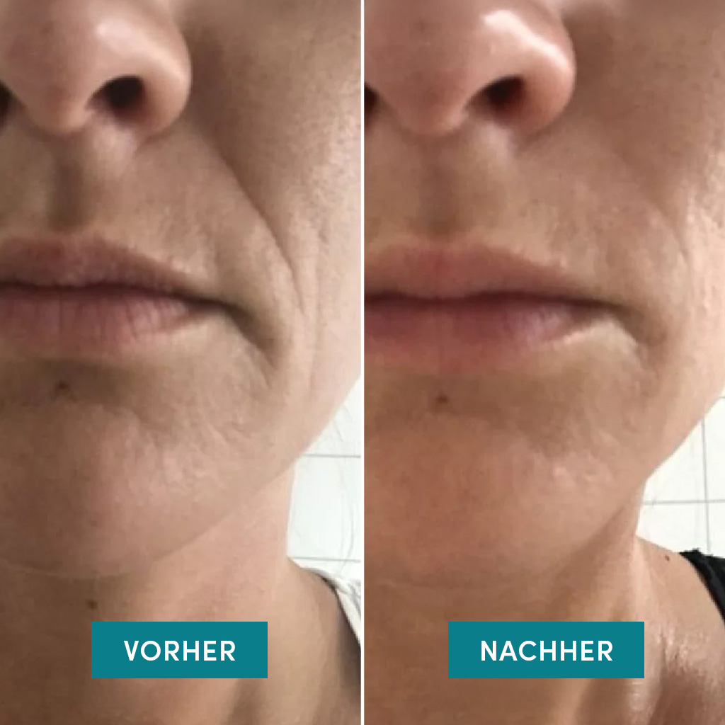 Apricot Mundpatches, Bild 4 von 5