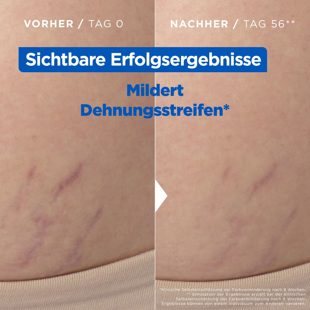 MIXA Niacinamide Stretchmark Oil, image 5 sur 5