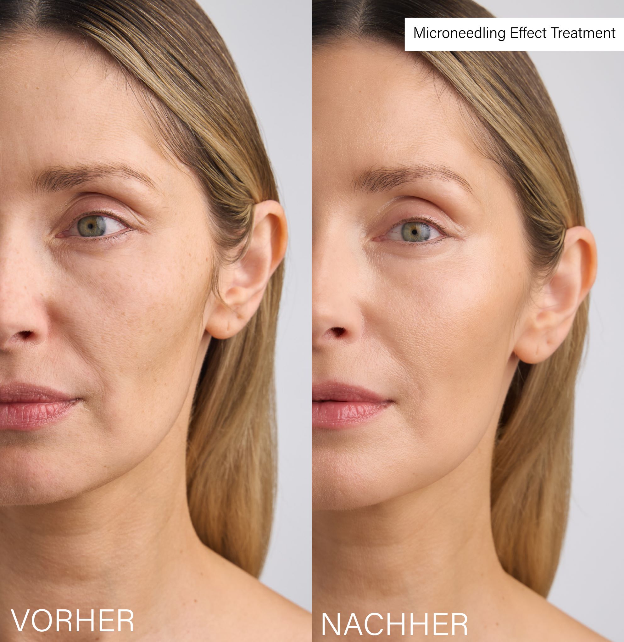 ROSENTAL Microneedling Effect Treatment, image 5 sur 5